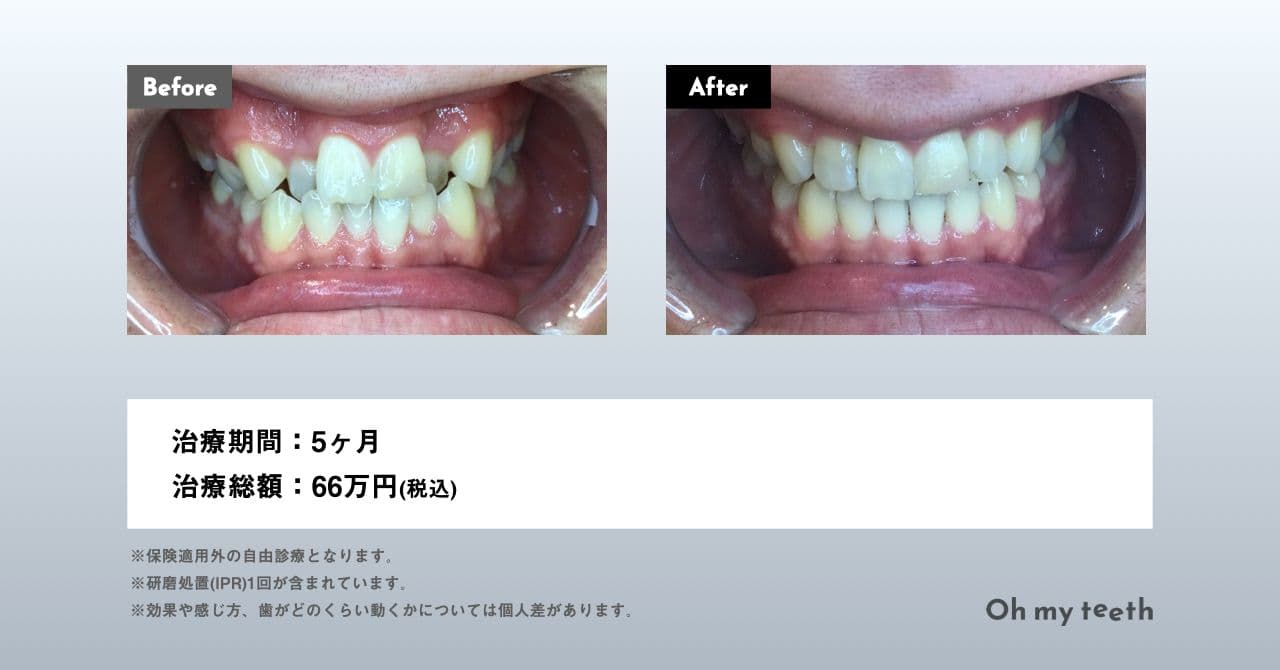 Oh my teeth症例画像(ガタガタ)