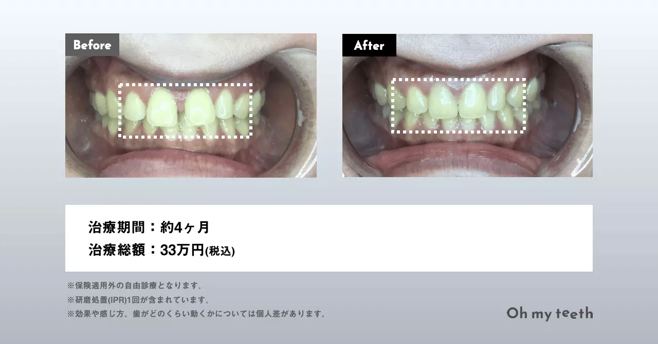 マウスピース矯正 Oh my teethのすきっ歯(空隙歯列)の症例