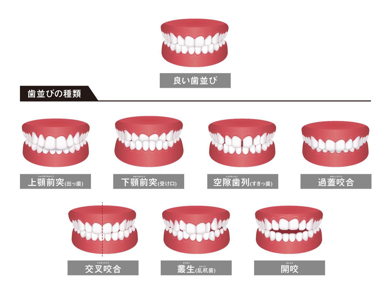 歯並びが悪くなる原因と種類・治療方法を解説