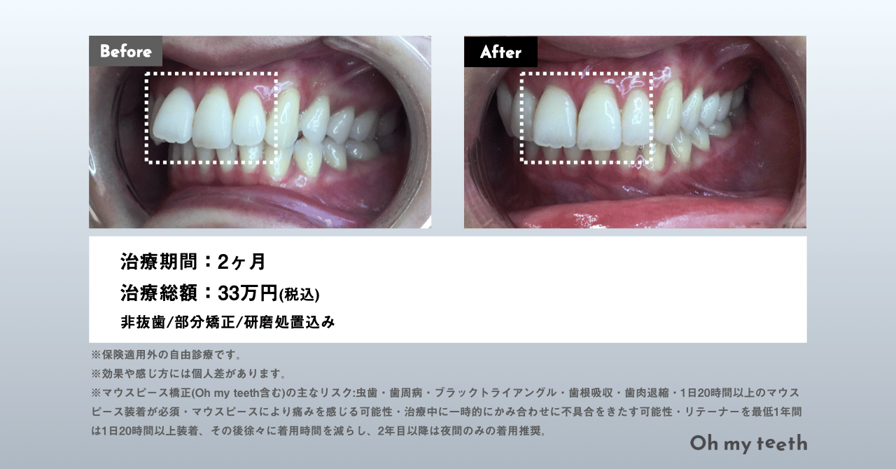 出っ歯 症例