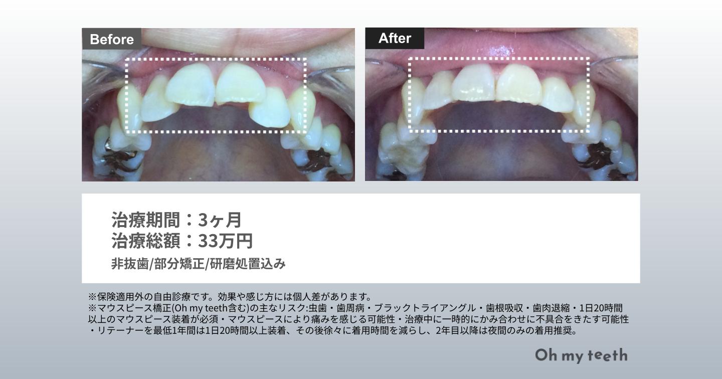 マウスピース矯正 Oh my teethの症例(部分矯正)