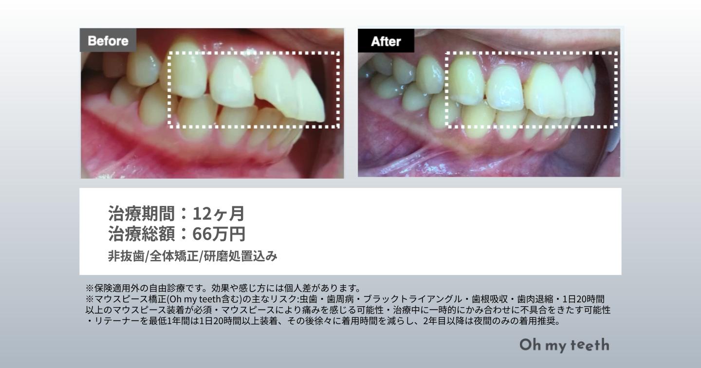 マウスピース矯正Oh my teethの出っ歯の症例(全体矯正)