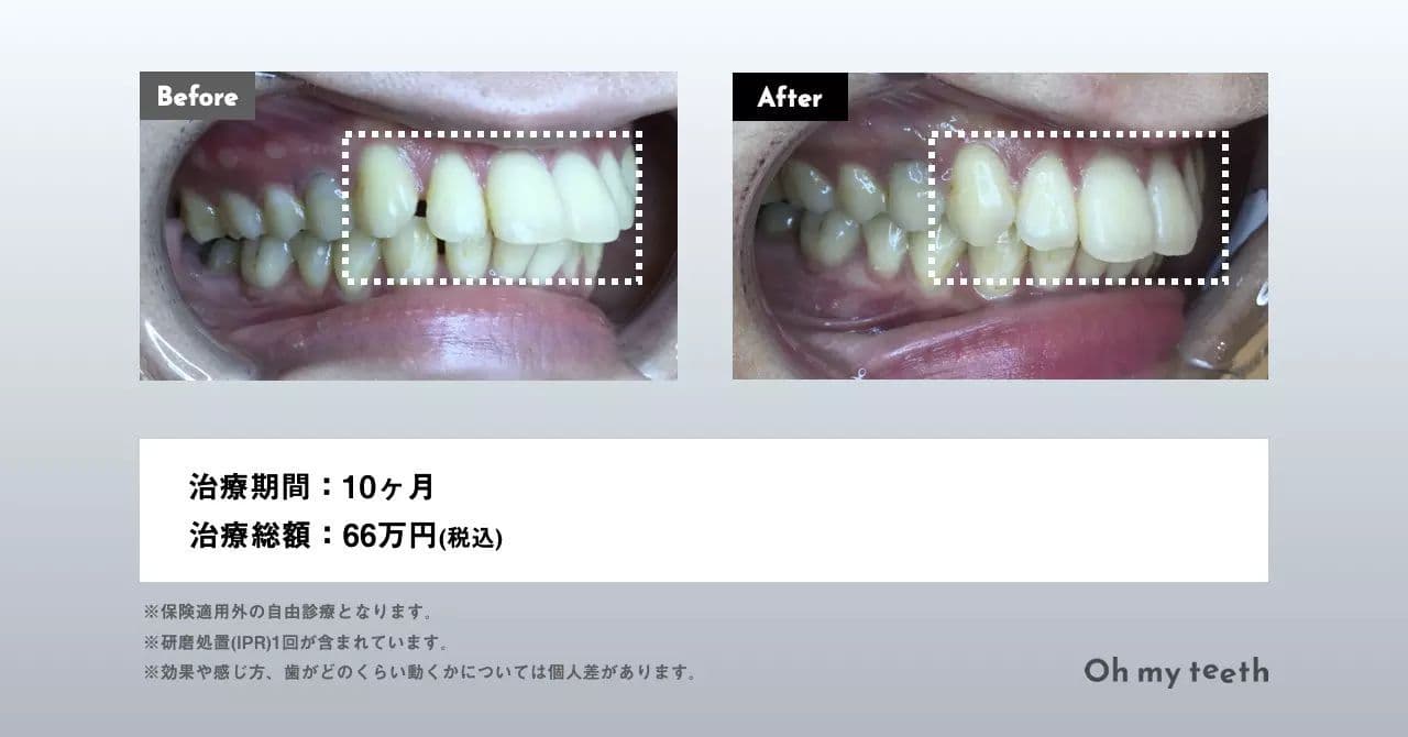 マウスピース矯正 Oh my teethの出っ歯の症例(全体矯正)