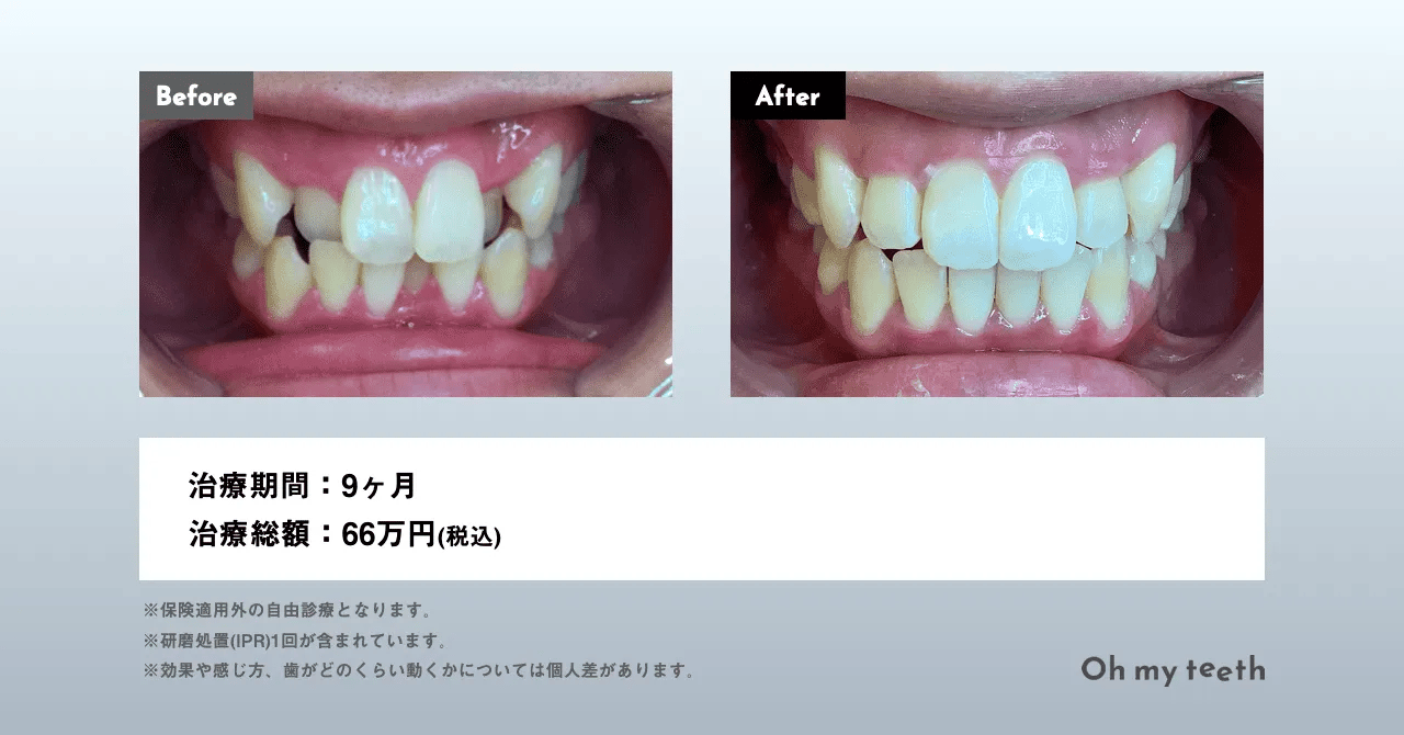 マウスピース矯正 Oh my teethの八重歯の症例(全体矯正)