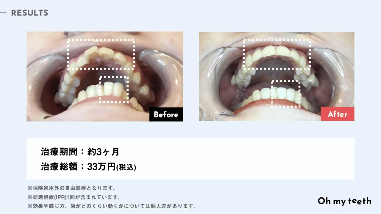 マウスピース矯正 Oh my teethの出っ歯の症例(部分矯正)