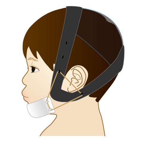 チンキャップの装着を表したイラスト