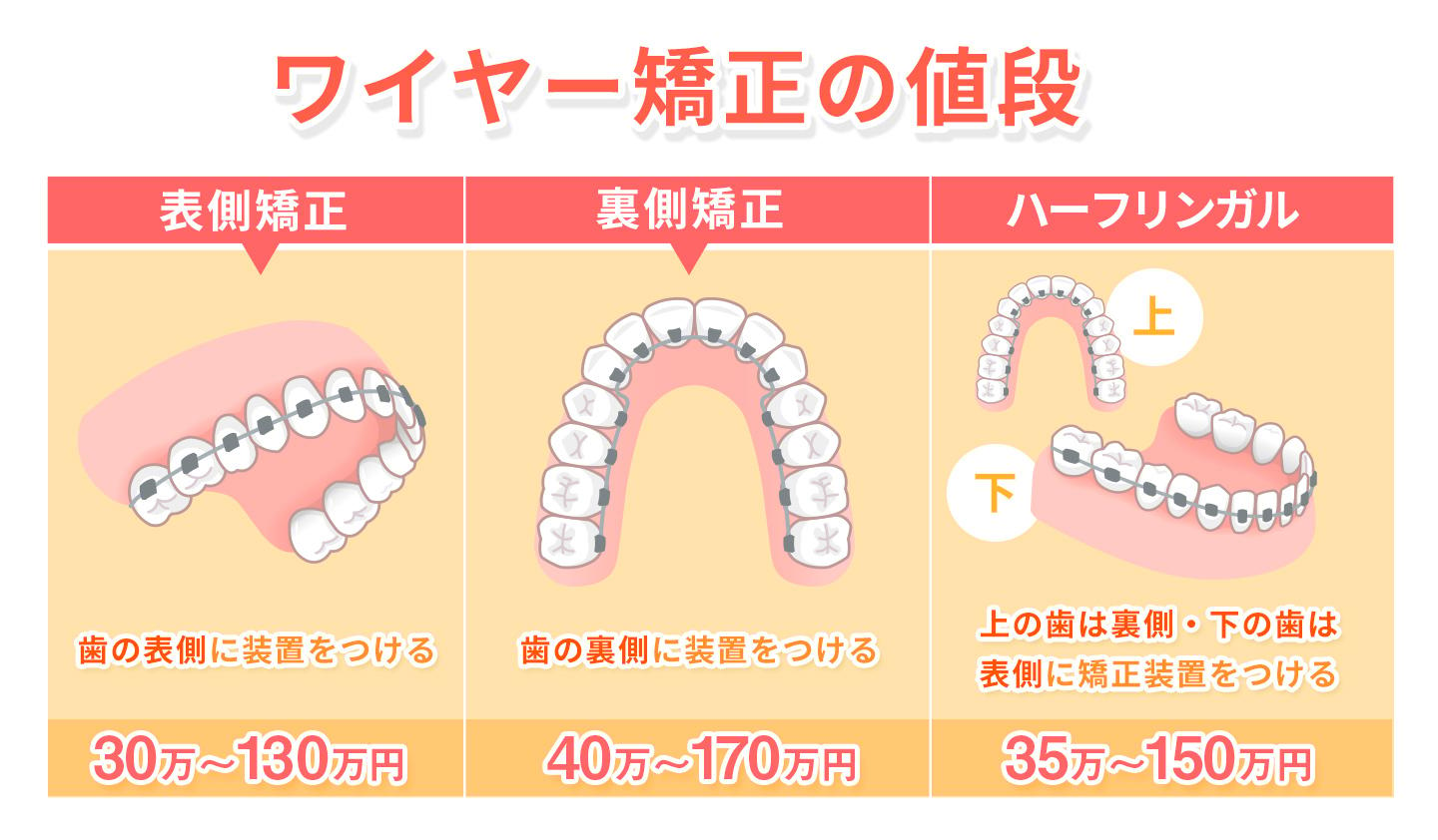 ワイヤー矯正の値段