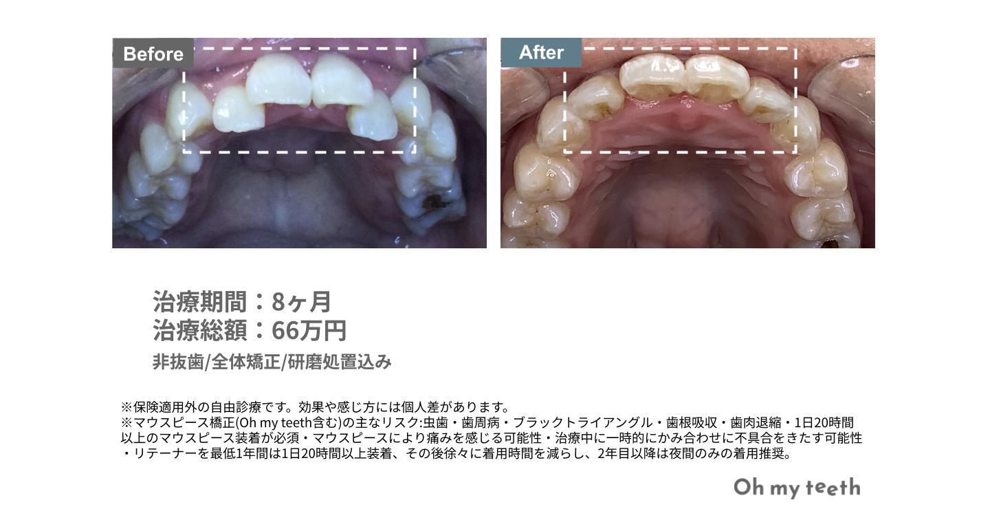 叢生・ガタガタの歯並びの症例写真
