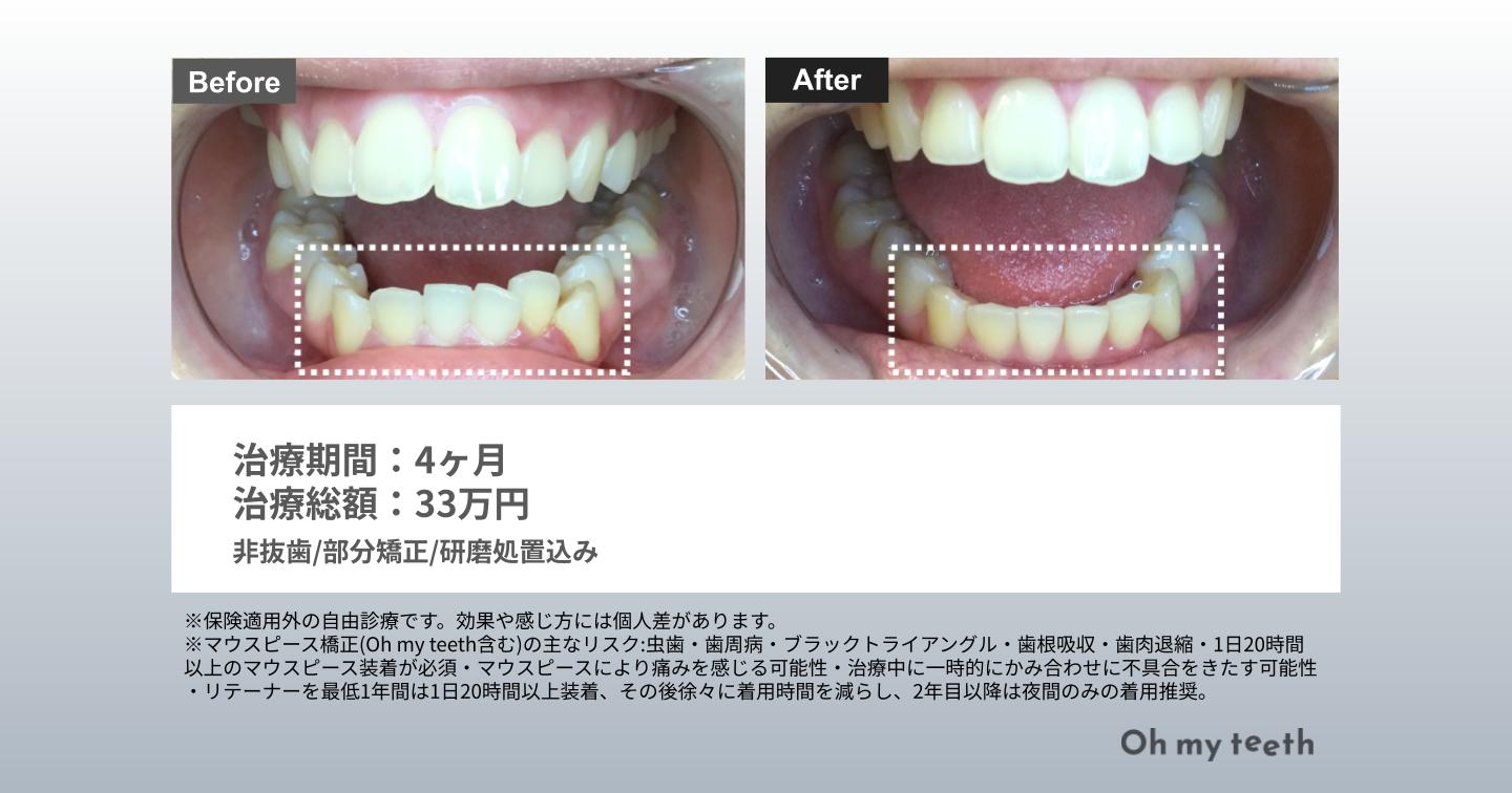 マウスピース矯正 Oh my teethの八重歯の症例(部分矯正)