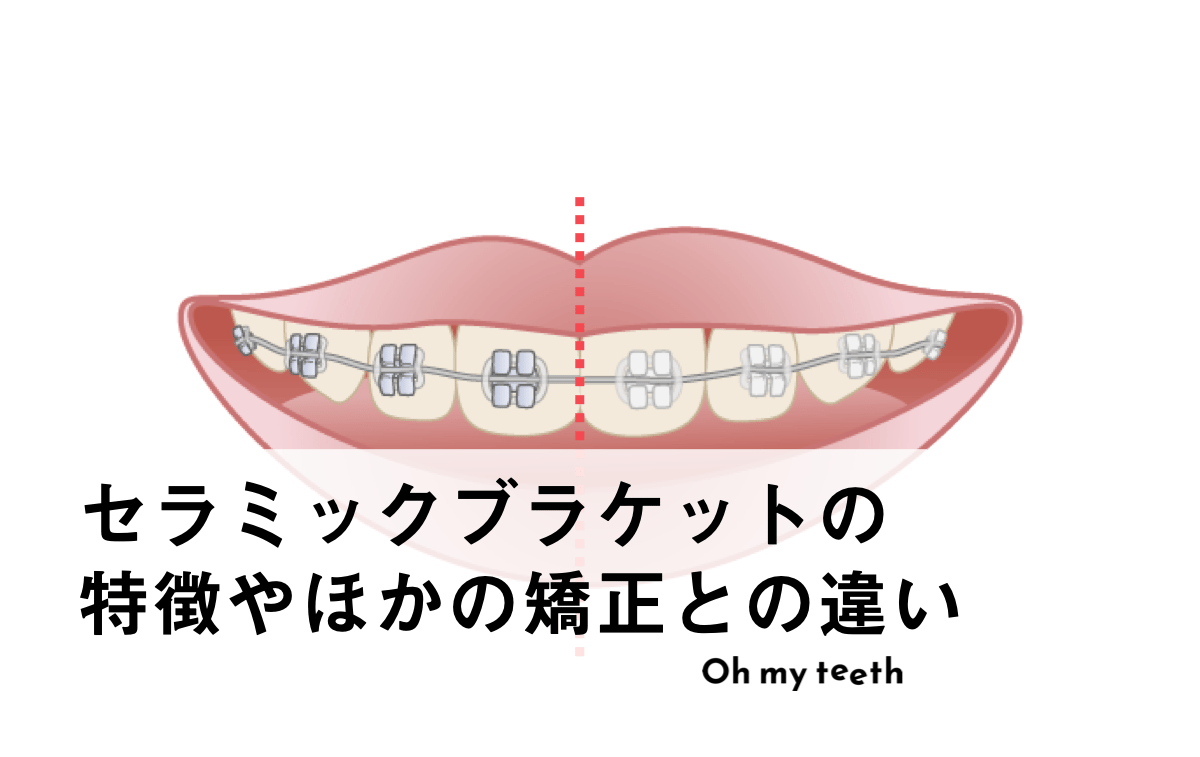 セラミックブラケットの特徴やほかの矯正との違い