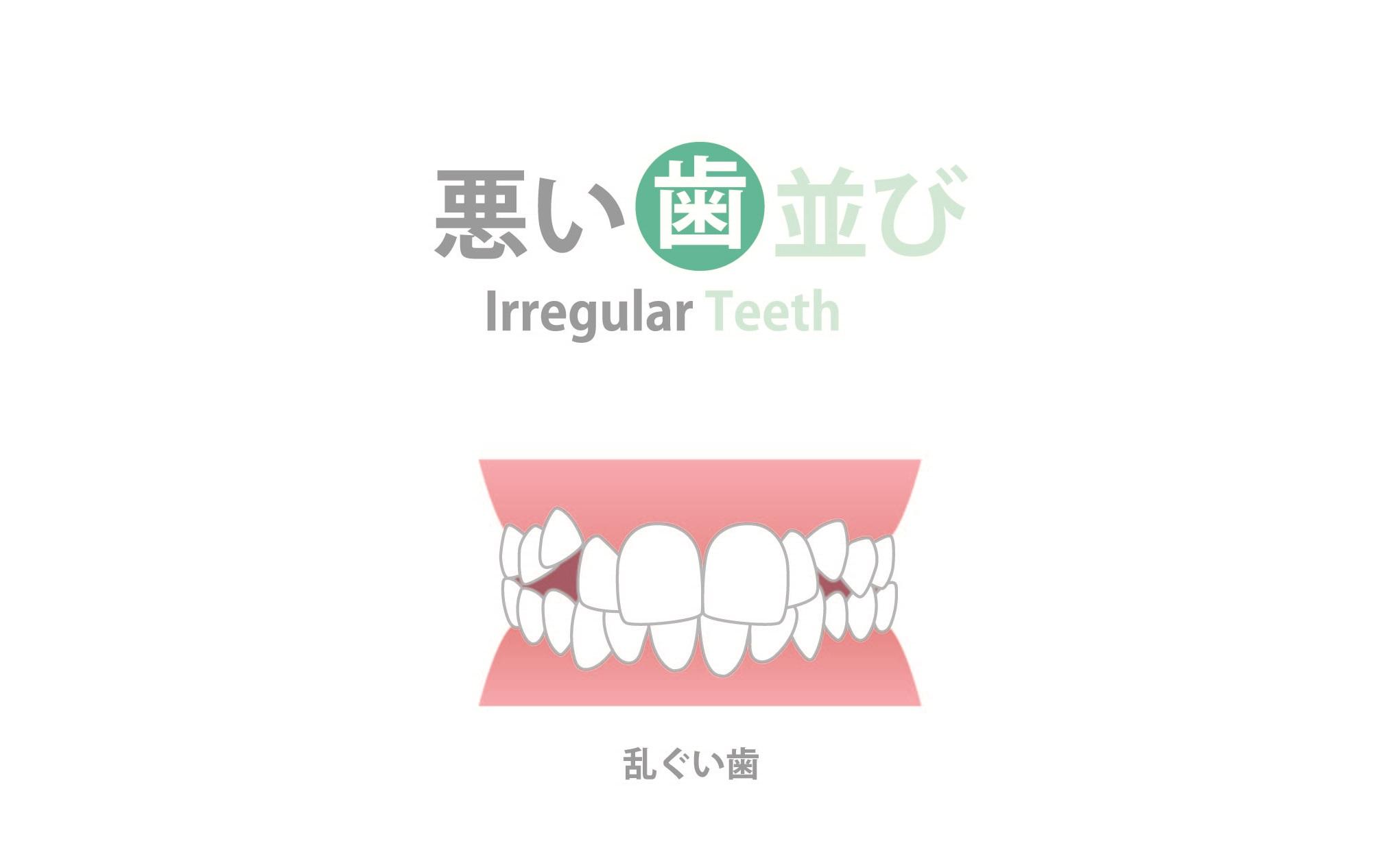 乱杭歯　マウスピース矯正