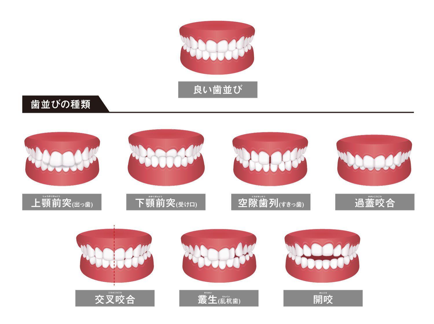 不正咬合の種類