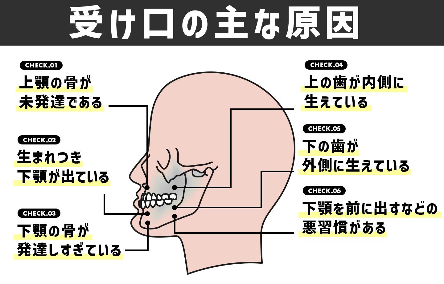 受け口の主な原因