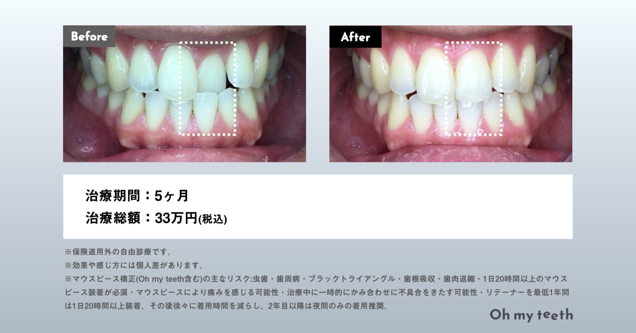 受け口（反対咬合）の症例