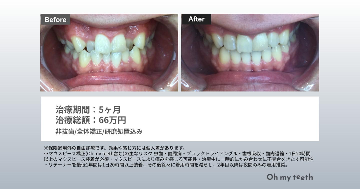 マウスピース矯正 Oh my teethの八重歯の症例(全体矯正)