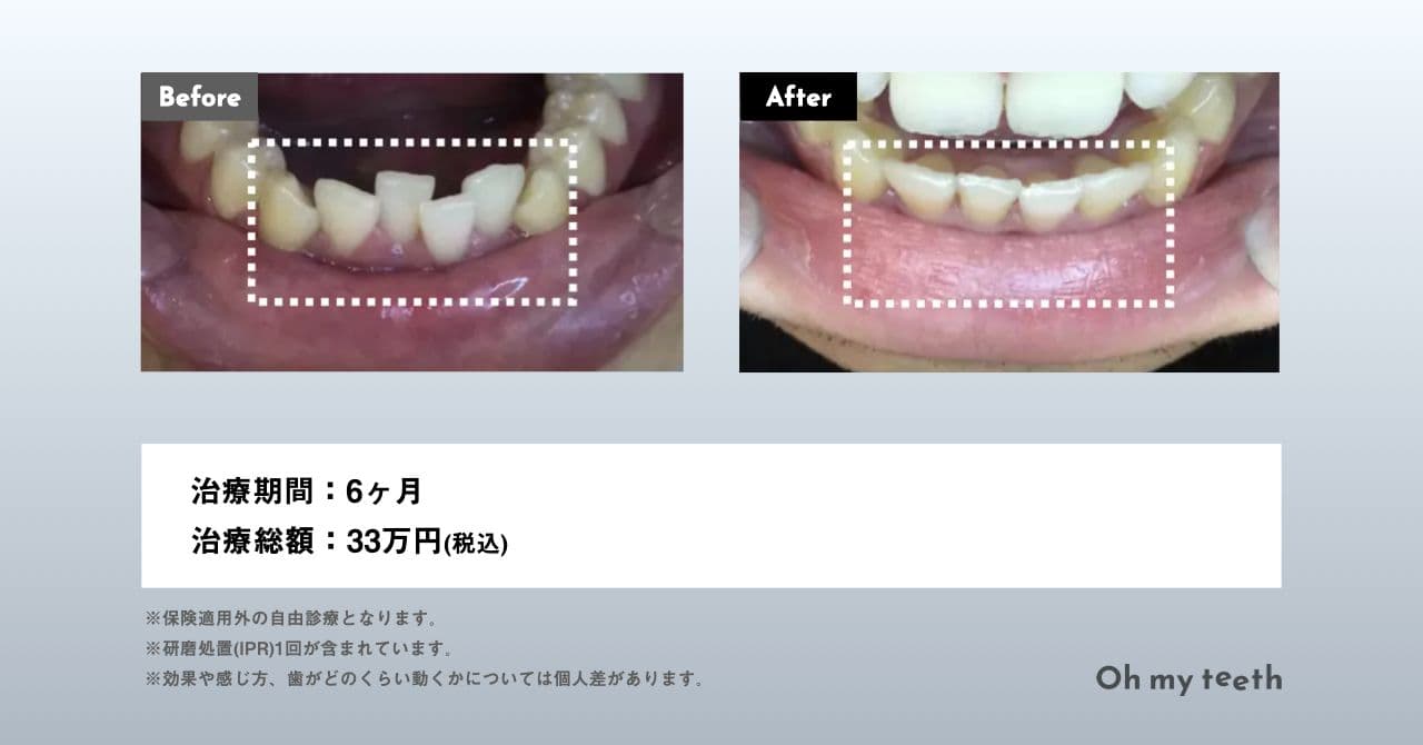 後戻りユーザーのマウスピース矯正 Oh my teethの症例