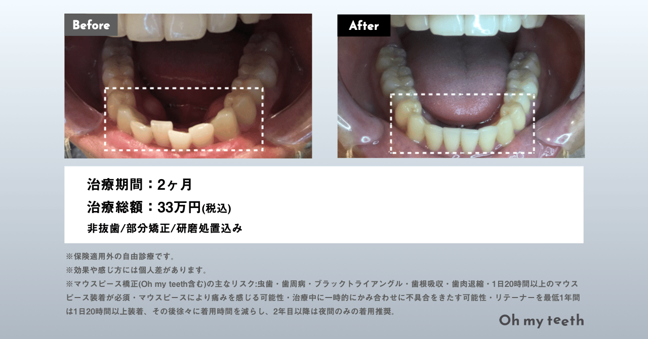 後戻りユーザーのマウスピース矯正 Oh my teethの症例(部分矯正)